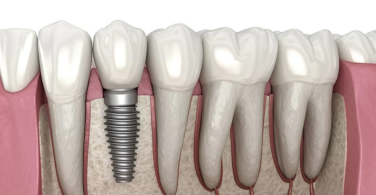 Peri Implantitis Inblog